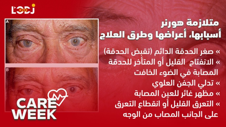 Care Week : متلازمة هورنر، أسبابها، أعراضها وطرق العلاج