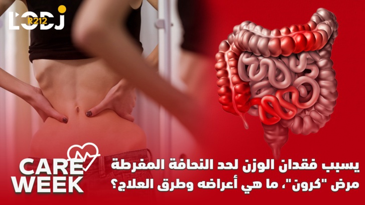 Care Week :  يسبب فقدان الوزن لحد النحافة المفرطة ، مرض "كرون"، ما هي أعراضه وطرق العلاج