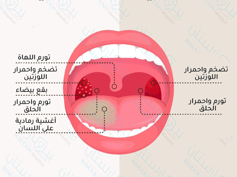 مخاطر التهاب اللوزتين عند الأطفال