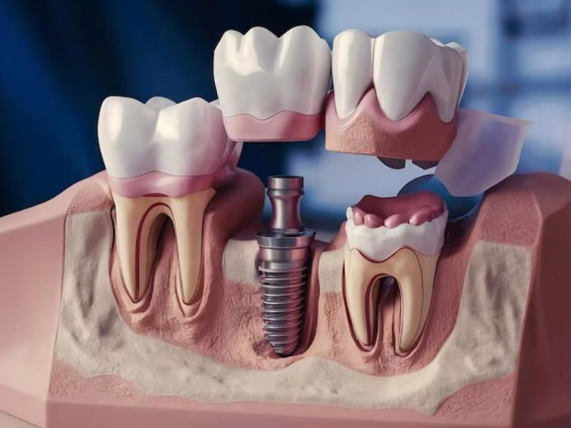زراعة الأسنان: الحل المثالي لتعويض الأسنان المفقودة