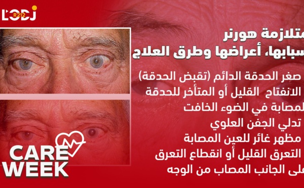 Care Week : متلازمة هورنر، أسبابها، أعراضها وطرق العلاج