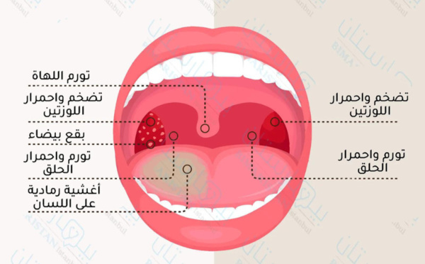 مخاطر التهاب اللوزتين عند الأطفال