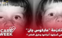 Care Week : متلازمة "ماركوس جان، ماهي أسبايها، أعراضها وطرق العلاج ؟