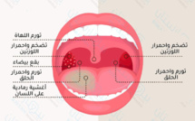 مخاطر التهاب اللوزتين عند الأطفال